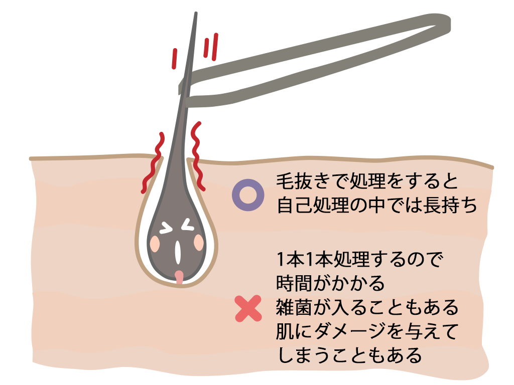 毛抜きでも毛根は死ぬ？やり方と脱毛との関係・痛くない方法は？ | 内科総合クリニック人形町