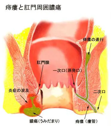 お尻の穴を締めるだけでやせる!?運動が苦手でもできる「肛門筋ダイエット」とは？(1/2)｜ウォーカープラス