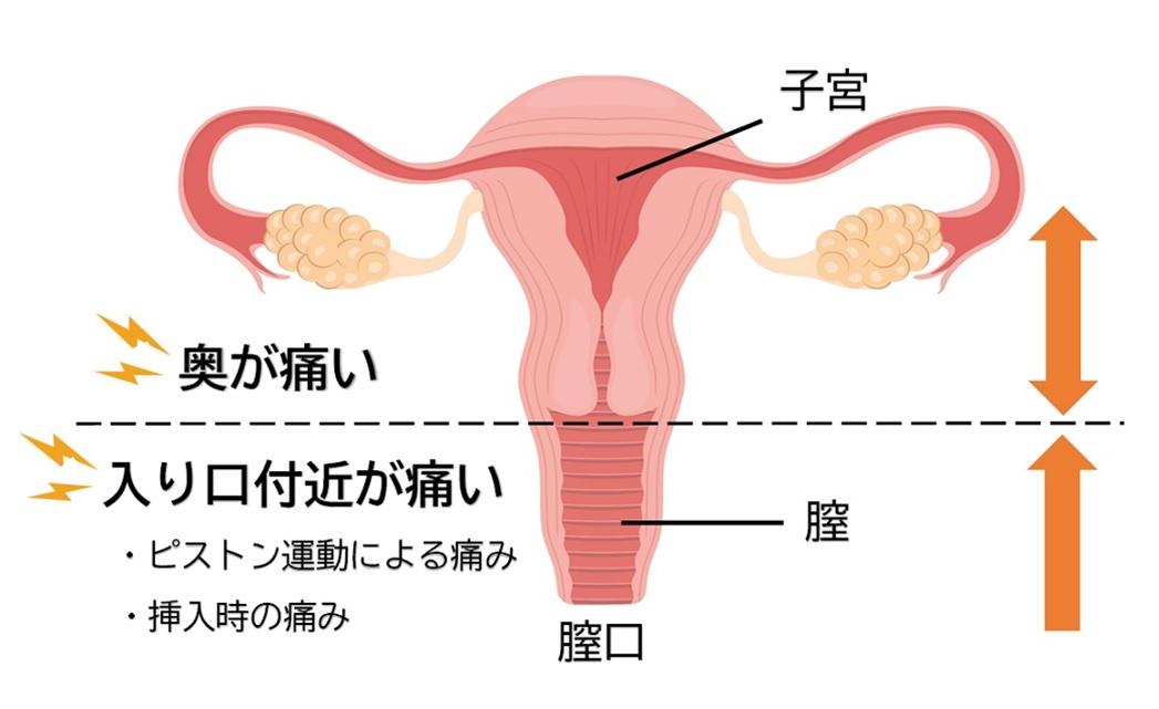 膣の上付き下付きの判別方法は？挿入のコツ - 夜の保健室