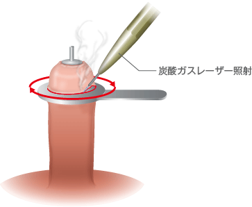 包茎男子必読】包茎でも風俗遊びはできる？風俗嬢の本音や利用時のポイントを解説｜駅ちか！風俗雑記帳