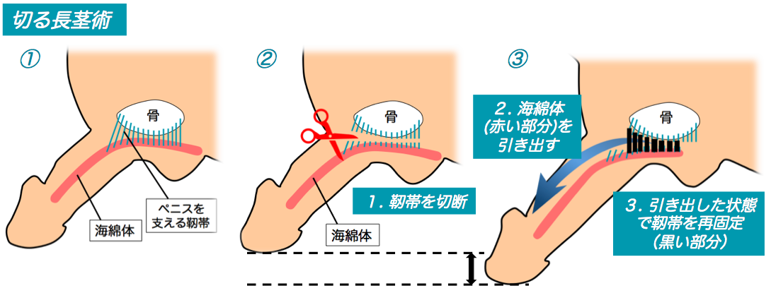 長茎術（サオを長く） | ペニス増大 | 男性泌尿器科【金沢中央クリニック】