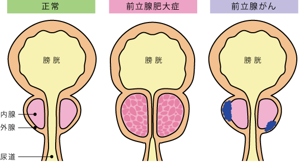 電磁ピストン×振動 前立腺マッサージ 2点同時責め