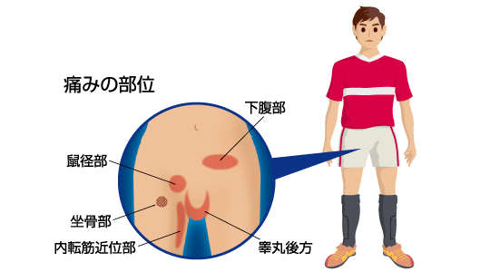 痛くないから大丈夫」⇒放置して大変なことに…太ももの付け根にできる「柔らかい膨らみ」や「腫れ」の正体【医師が解説】 | ゴールドオンライン