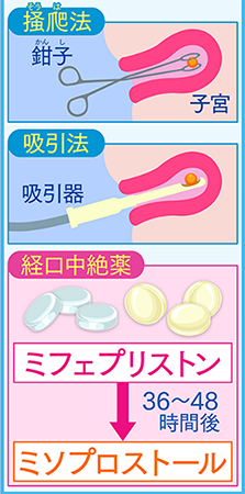 中絶経験などからかかるPASとは︖心の病気の予防法などを解説 | DNA先端医療