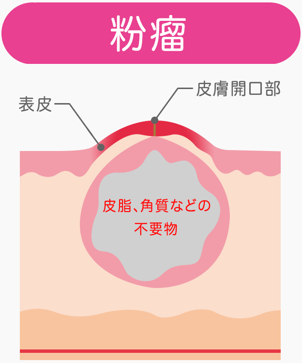 ノスカナゲル・東亜製薬のスキンケアを使った口コミ -東亜製薬 ・アクノンクリーム ・ノスカナゲル