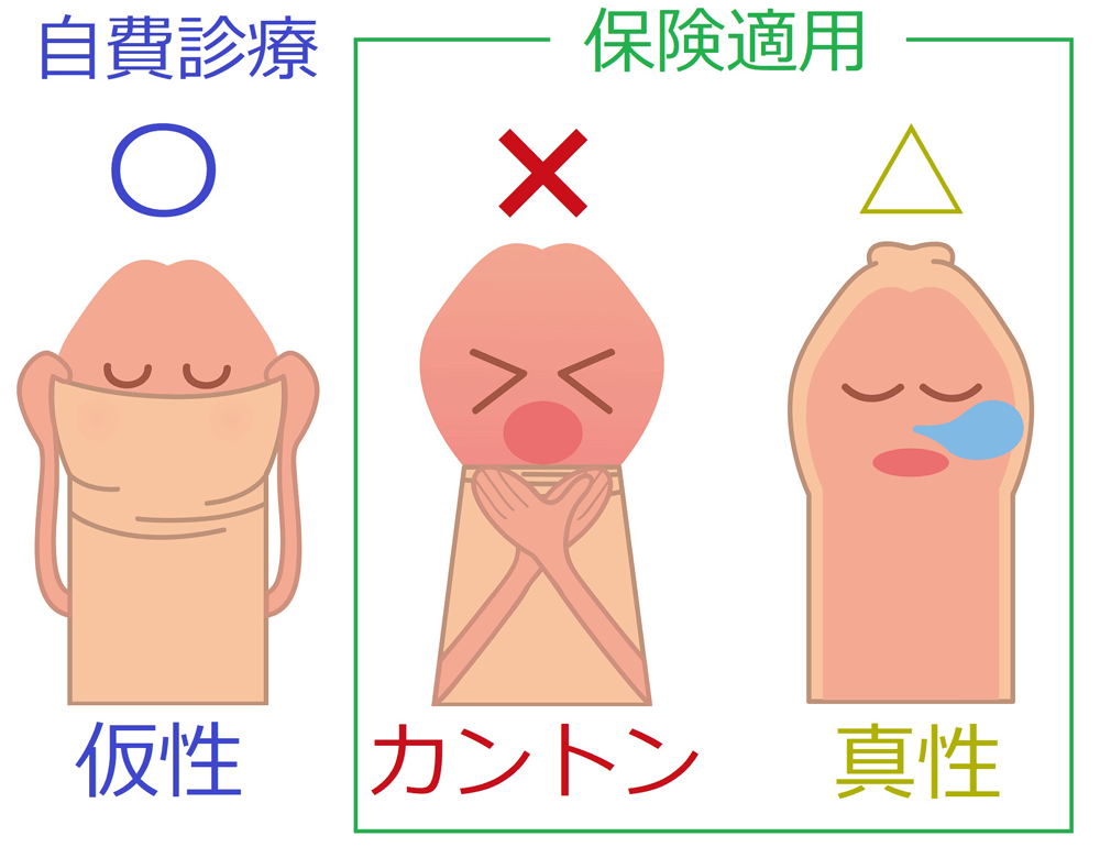 包茎手術について | 包茎手術の東京ノーストクリニック【公式】